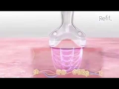 MLS05 قابل حمل 40K حفره RF دستگاه کاهش سلولیت اولتراسونیک